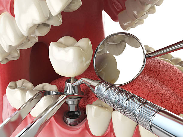 Best Emergency Dentist for Lost Fillings or Crowns in Mount Olive, MS